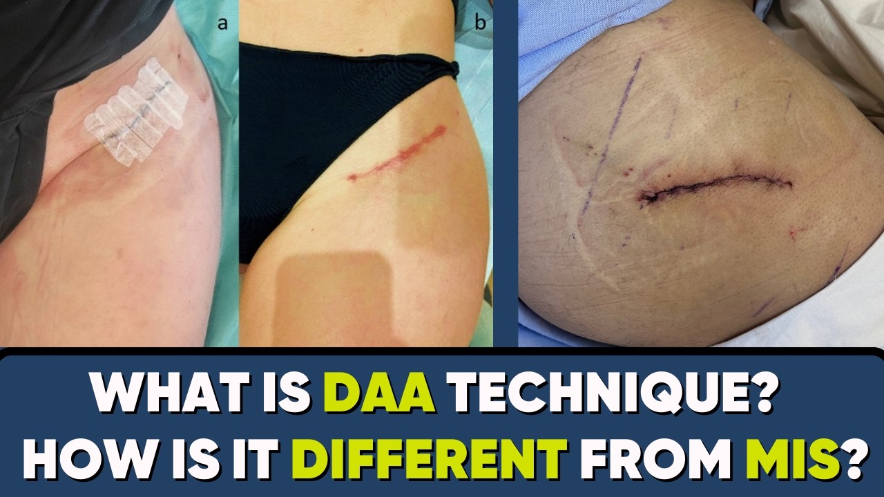 What's Direct Anterior Approach (DAA)? How its different from other approaches of hip surgery?