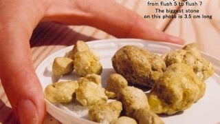 Liver Detoxify, Gall Stone Cleanse, Removal Of Gallstones, Gallstone Attacks