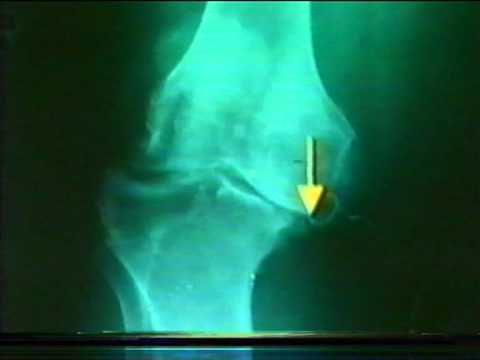 Artrita exacerbarii genunchiului