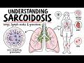 Sarcoidosis Explained Non-Caseating Granulomas