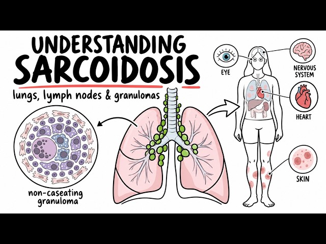 Sarcoidosis Explained Non-Caseating Granulomas