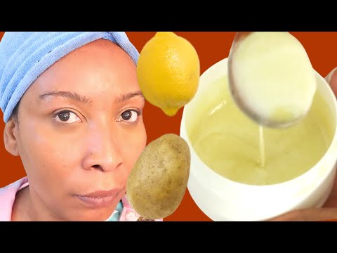 , title : 'I WASH MY FACE WITH POTATO AND LEMON! LOOK WHAT HAPPENED, NO MORE HYPERPIGMENTATION ON MY SKIN'