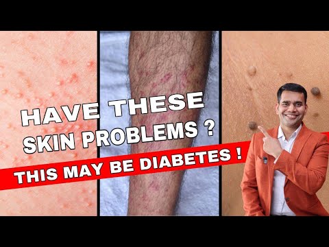 12 Skin Warning Signs of Diabetes | Diabetes Skin Signs