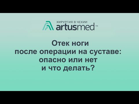 Отек после эндопротезирования сустава, мой личный пример. Причины и лечение и методы профилактики.