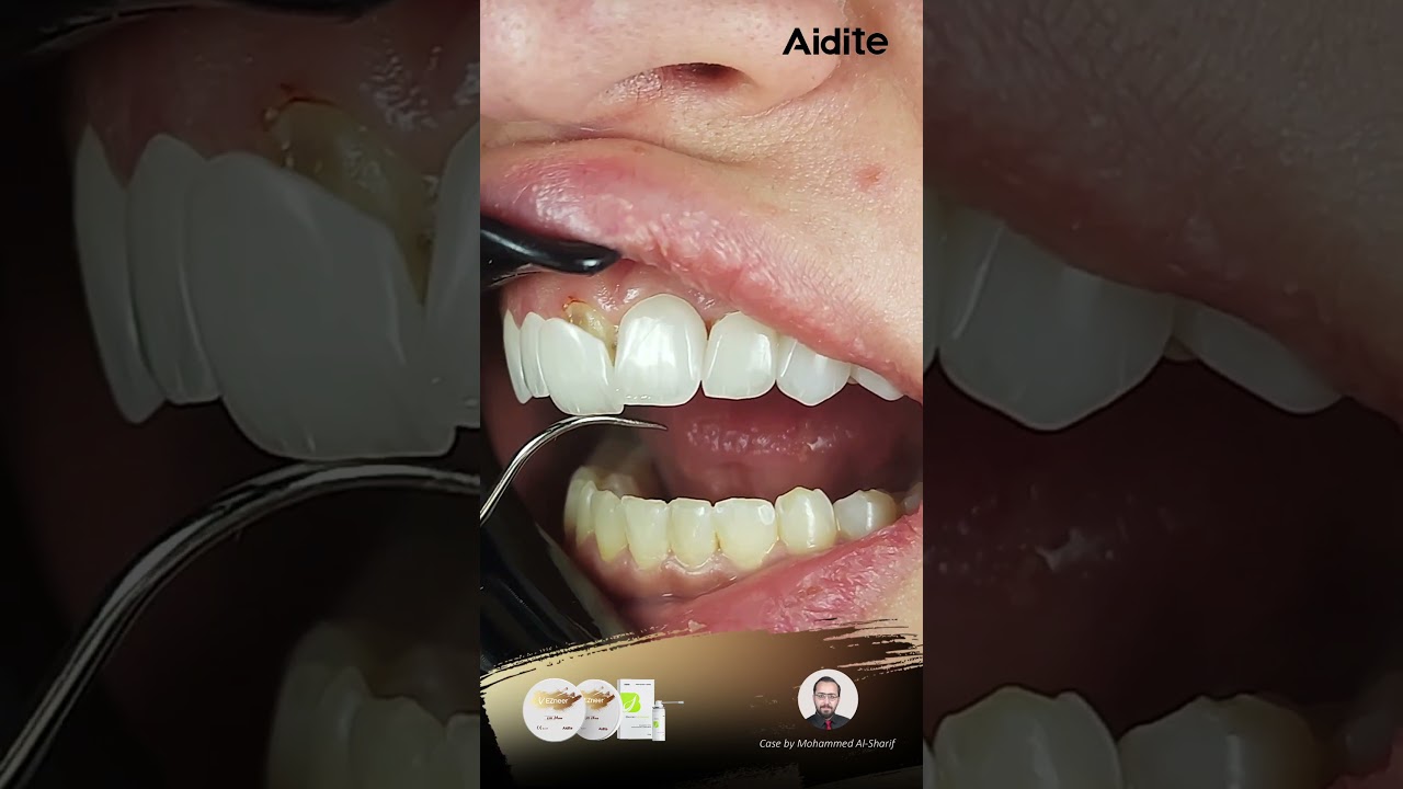 Meet Aidite’s Aesthetic Excellence | EZneer Case with Mohammed Al-Sharif