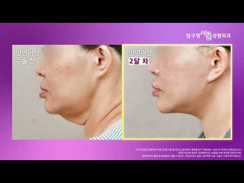 #안면거상거상술잘하는병원 찾으신다면? 목주름까지 싹!