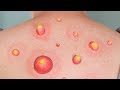 HUGE ZITS ON BACK