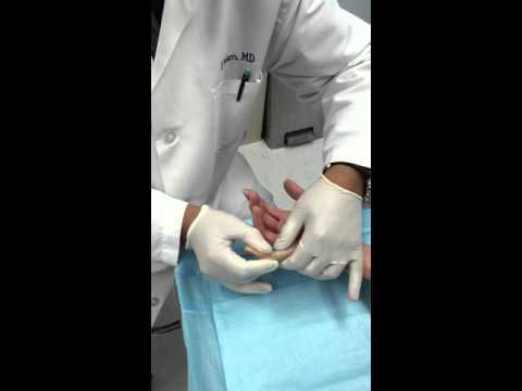 Treating Dupuytren's Contracture: Xiaflex (2nd Stage) w/ Dr. Sohel Islam at Advanced Specialty Care