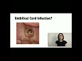Umbilical Cord Infections