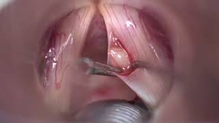 Mucous retention cysts of  vocal fold / Quiste mucoso de cuerda vocal