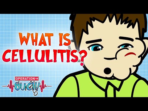 What is Cellulitis? | Operation Ouch
