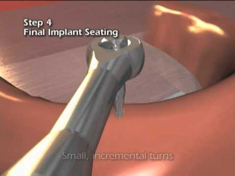 Kung paano dagdagan ang laki ng suso nang walang plastic Surgery para sa dibdib mastitis