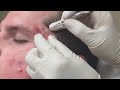 Super Satisfying Blackhead Removal Super Satisfying Blackhead Removal
