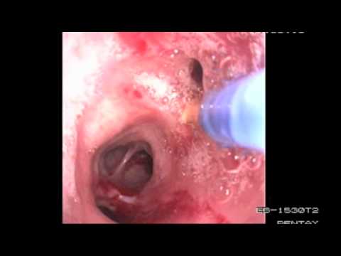 Bronchoscopy Procedure - See inside the lungs!