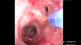 Bronchoscopy Procedure - See inside the lungs!
