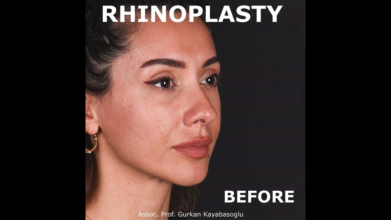Dr Gurkan Kayabasouglu Plastic Surgeon in Istanbul, Turkey - Rhinoplasty