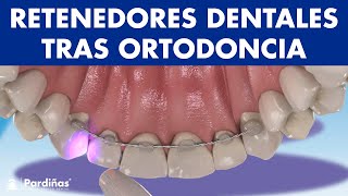 RETENEDORES DENTALES - Cómo evitar que se muevan los dientes tras la ortodoncia ©
