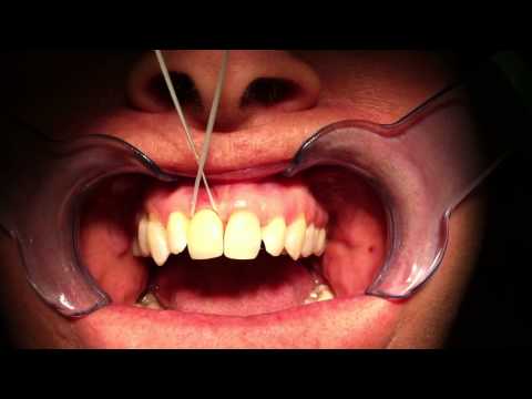 How to floss Single Anterior Implants – use PTFE unwaxed floss...