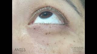 Eliminación de verrugas en los párpados | #Shorts