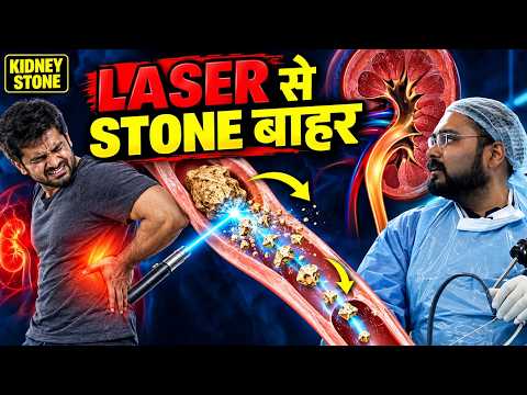 Kidney Stone Laser Operation | पथरी Laser से कैसे तोड़ते हैं?