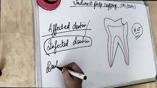 indirect pulp capping in primary teeth (McDonald - Textbook)