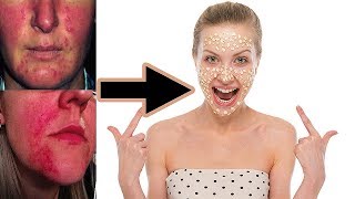 How to Cured Rosacea // Irritation // Redness Naturally - Rosacea Treatment