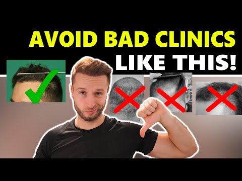 Find a Perfect Hair Transplant Clinic in 10 Minutes! My Proven Elimination Method
