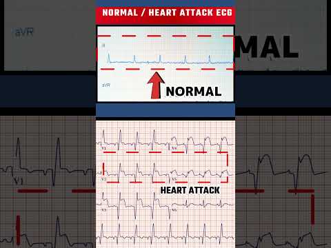 हार्ट अटैक का ECG - HEART ATTACK ECG VS NORMAL ECG#shorts
