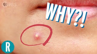 What's the Deal with Acne?