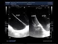 Ultrasound Video Showing A Huge Abdominal Cyst