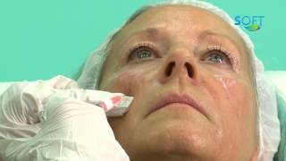 Relleno de pómulos con ácido hialurónico