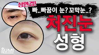 #상안검 처진눈성형으로 꼬막눈 탈출