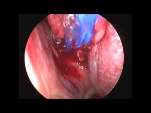 Sphenoid Dilation and Irrigation