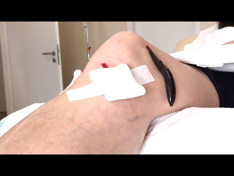 Prostatahyperplasie Struktur Prostatilen Kerzen 50 mg 10 in