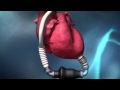 Ventricular Assist Devices 