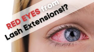 Red Eyes After Eyelash Extensions – How to Treat & Prevent