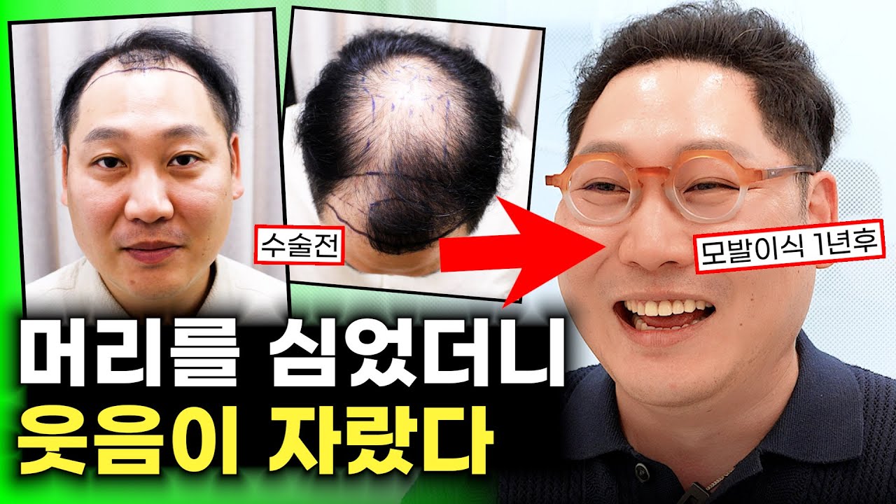모발이식 6000모 1년 후기! 모발이식은 그냥 필수입니다