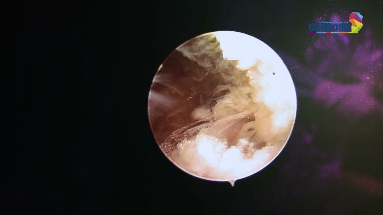 La salud pública de Córdoba incorpora cirugías endoscópicas de columna