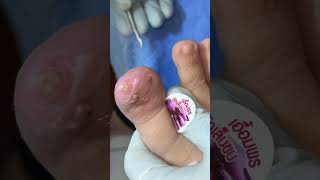 Ep_8162 Big Ingrown toenail removal 👣 Will my screaming make my building crack? 😄 (clip from Thai...