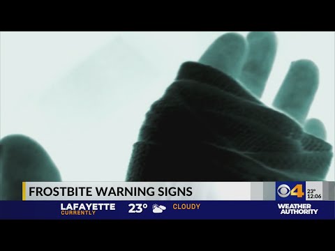 Frostbite warning signs