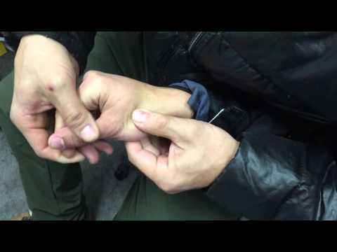 指の脱臼 - 指の脱臼とは何か、治療方法、症状、対処法