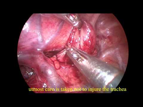 Thoracoscopic Repair of TEF Techniques & Challenges