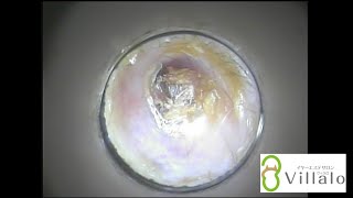 耳掃除動画vol.14「奥に押し込んじゃいました」