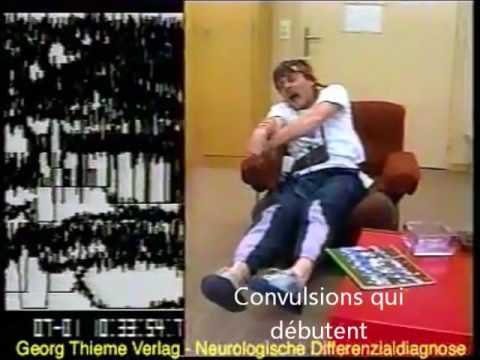 EPILEPSIE GRAND MAL