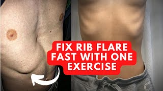 How To Fix Rib Flare With This 1 Powerful Exercise