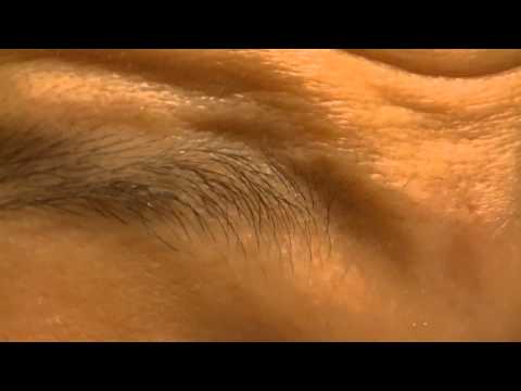 Morgellons Eye Strings Are Hard TO Get Out