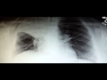 Pneumonia on Chest X-Ray: Most Important Things.