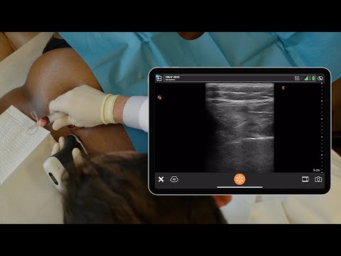 PRP SI Joint and Gluteal Bursal Injections