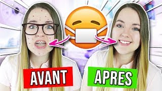 AVOIR UN APPAREIL DENTAIRE : AVANT VS APRES !