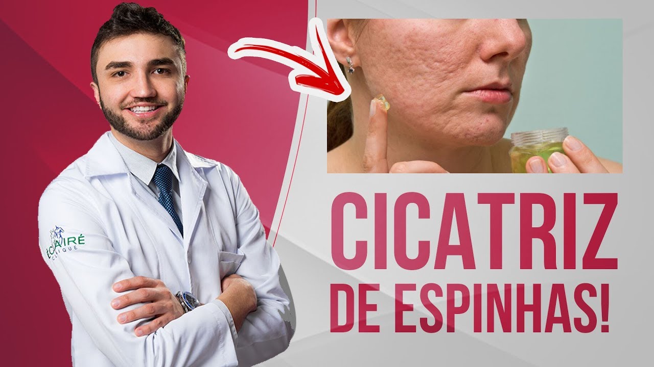 COMO TRATAR CICATRIZES DE ACNE (ESPINHA) - 5 ÓTIMAS DICAS - DR LUCAS FUSTINONI - CRMPR 30155